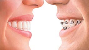 Brackets vs. Invisalign Which one to choose?