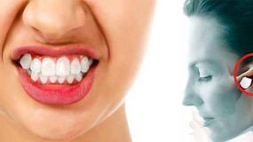 Bruxism destroys teeth